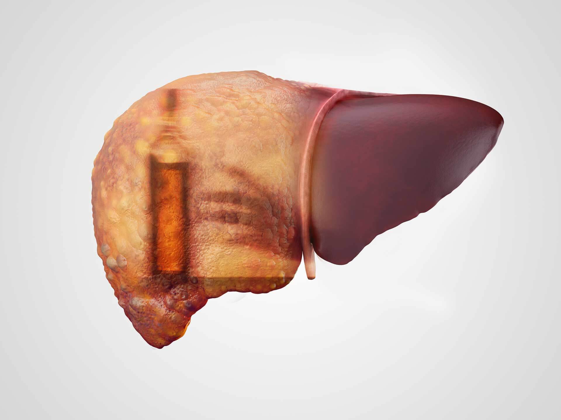 Yes, Alcohol Can Cause Cancer